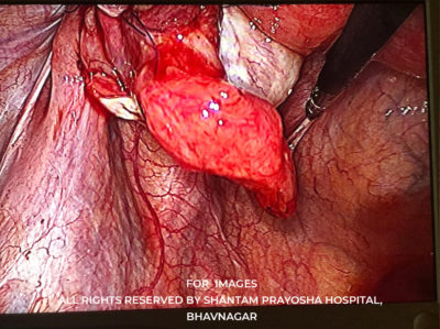 Laparoscopic-By Shantam Prayosha Hospital-02