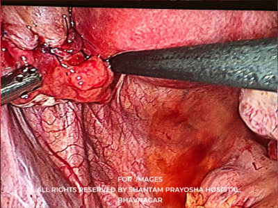 Laparoscopic-By Shantam Prayosha Hospital-03