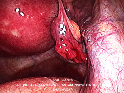 Laparoscopic-By Shantam Prayosha Hospital