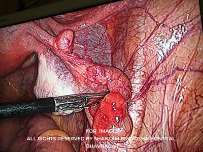 Laparoscopic-By Shantam Prayosha Hospital