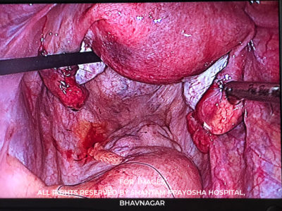 Laparoscopic-By Shantam Prayosha Hospital