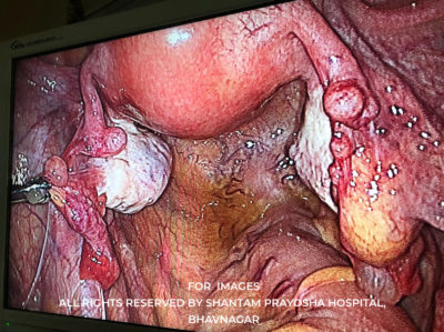 Laparoscopic-By Shantam Prayosha Hospital