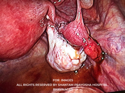 Laparoscopic-By Shantam Prayosha Hospital