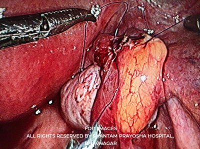 Laparoscopic-By Shantam Prayosha Hospital