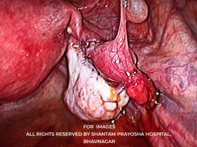 Laparoscopic-By Shantam Prayosha Hospital